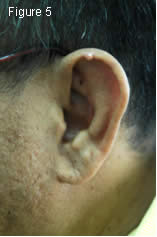 Figure 5: left side face and ear
