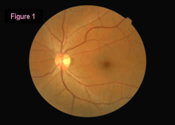 retinal image 1