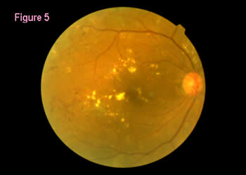 retinal image 5