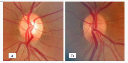 Figure 1. Color fundus photograph.