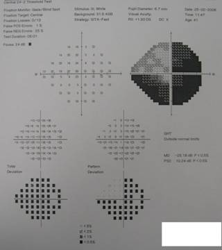 Figure 2. Humphrey single field analysis of patient&rsquo;s right eye
