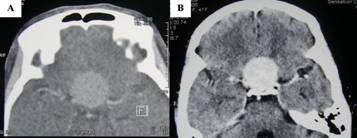 Figure3: CT brain