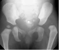 X-ray hips